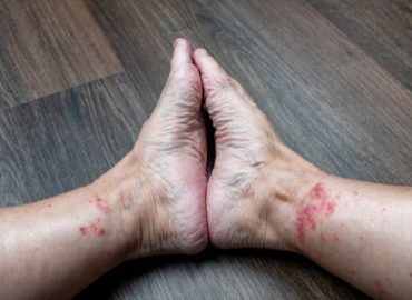 Vasculite: quando l'infiammazione colpisce i vasi sanguigni