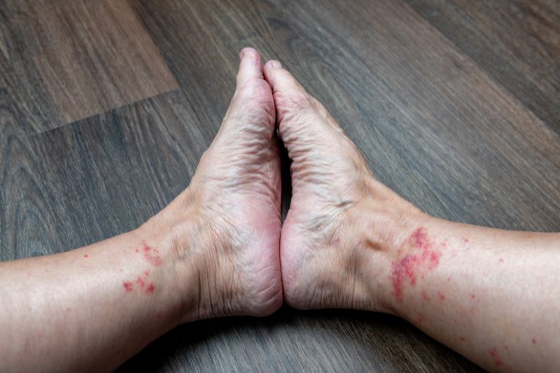 Vasculite: quando l’infiammazione colpisce i vasi sanguigni